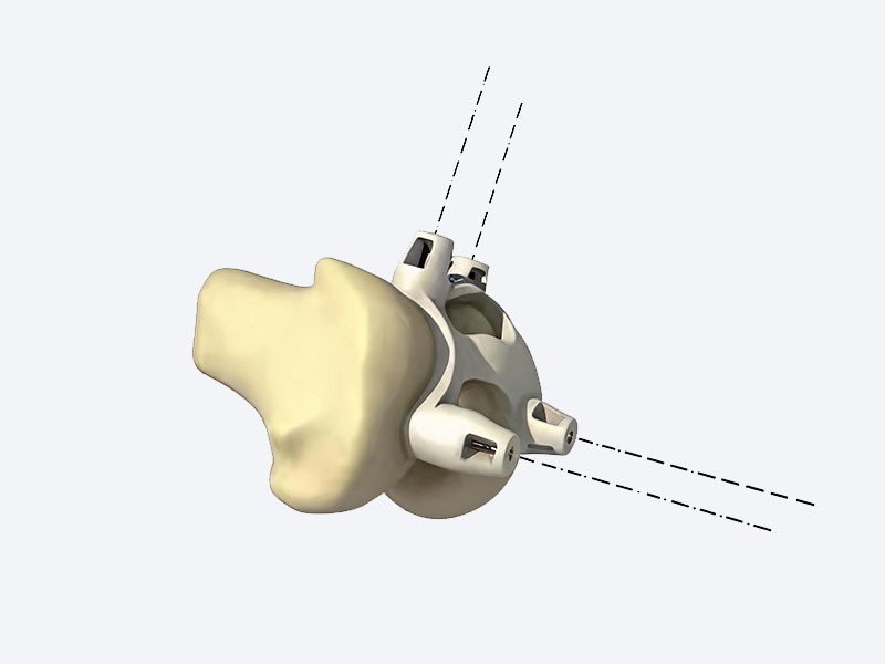 Customized surgical guide plate